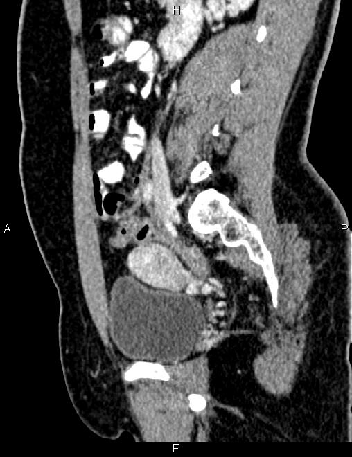 Bilateral ovarian teratoma (Radiopaedia 83131-97503 D 53).jpg