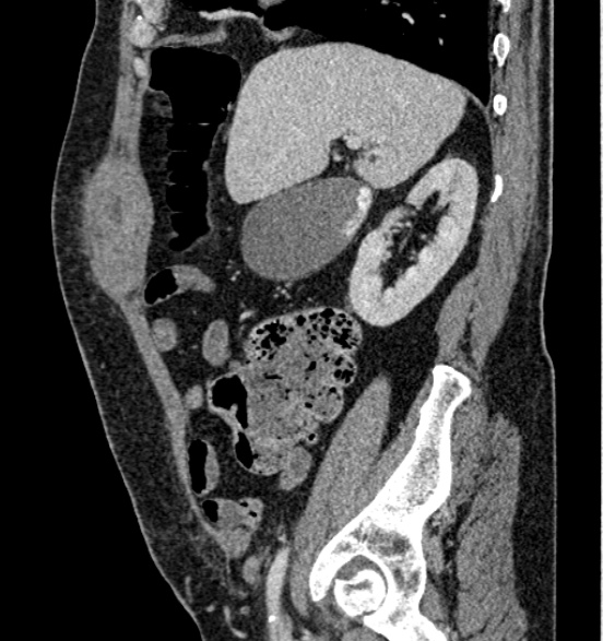 File:Bilateral rectus sheath hematomas (Radiopaedia 50778-56252 B 26).jpg