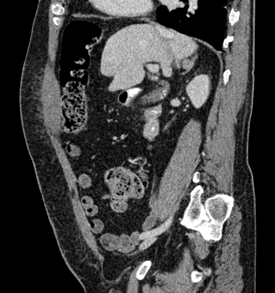 Bilateral rectus sheath hematomas (Radiopaedia 50778-56252 B 31).jpg