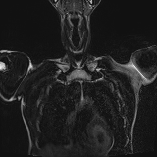 Bilateral spinoglenoid notch ganglion cysts (Radiopaedia 29577-30082 Coronal T2 22).jpg