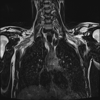 Bilateral spinoglenoid notch ganglion cysts (Radiopaedia 29577-30082 Coronal T2 50).jpg