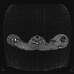 File:Bilateral spinoglenoid notch ganglion cysts (Radiopaedia 29577-30082 E 3).jpg