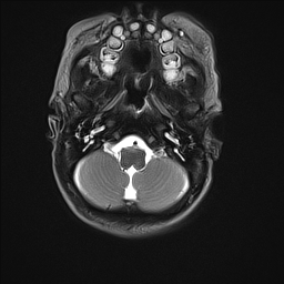 File:Bilateral subdural hemorrhage and parietal skull fracture (Radiopaedia 26058-26190 Axial T2 6).png