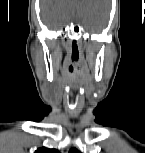 Bilateral submandibular sialolithiasis with sialadenitis (Radiopaedia 70721-80881 Coronal non-contrast 42).jpg