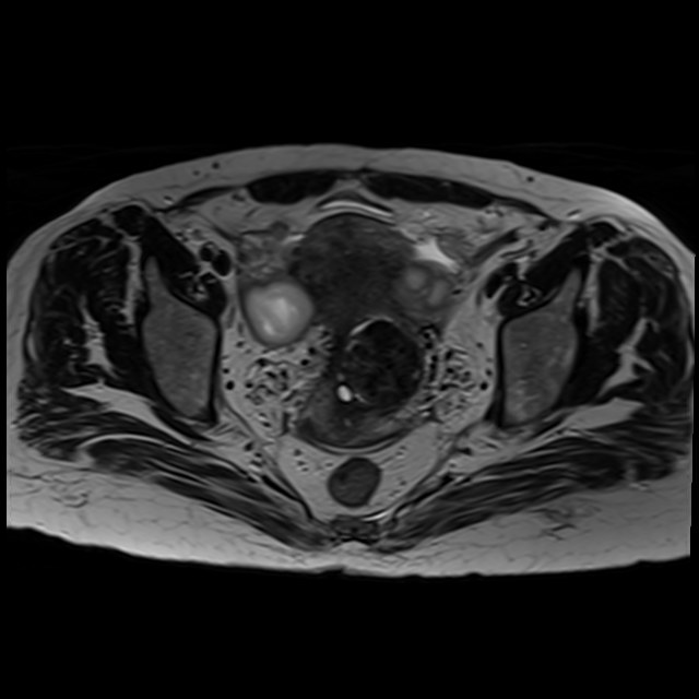 Bilateral tubo-ovarian abscesses (Radiopaedia 58635-65829 Axial T2 27).jpg