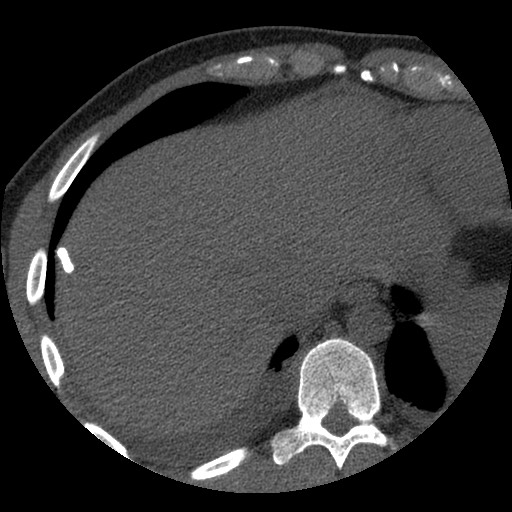 File:Bile leak from liver traumatic laceration (Radiopaedia 63463-72077 Axial Biliscopin 13).jpg