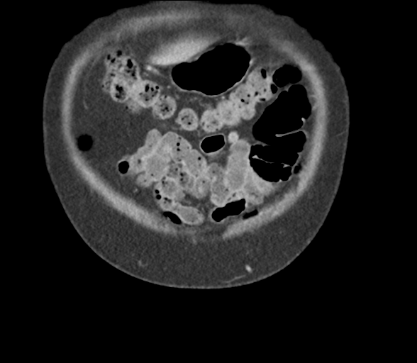 File:Bladder papillary urothelial carcinoma (Radiopaedia 48119-52951 C 10).png
