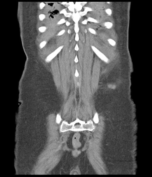 Bladder rupture post renal biopsy (Radiopaedia 30863-31572 Coronal non-contrast 50).jpg