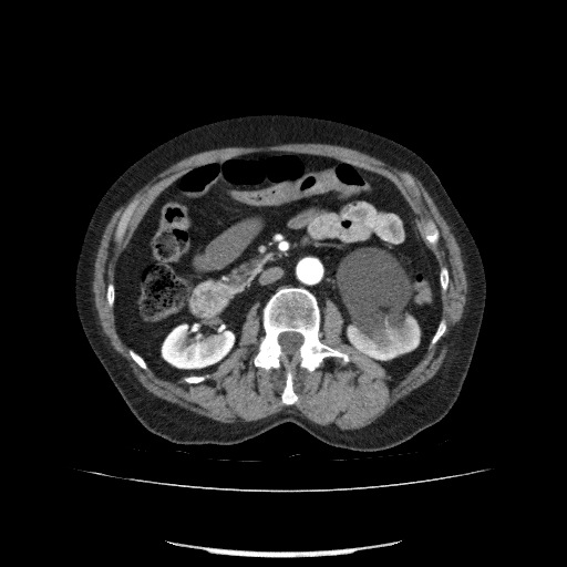 File:Bladder tumor detected on trauma CT (Radiopaedia 51809-57609 A 109).jpg