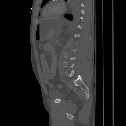 File:Blunt abdominal trauma with solid organ and musculoskelatal injury with active extravasation (Radiopaedia 68364-77895 Sagittal bone window 64).jpg