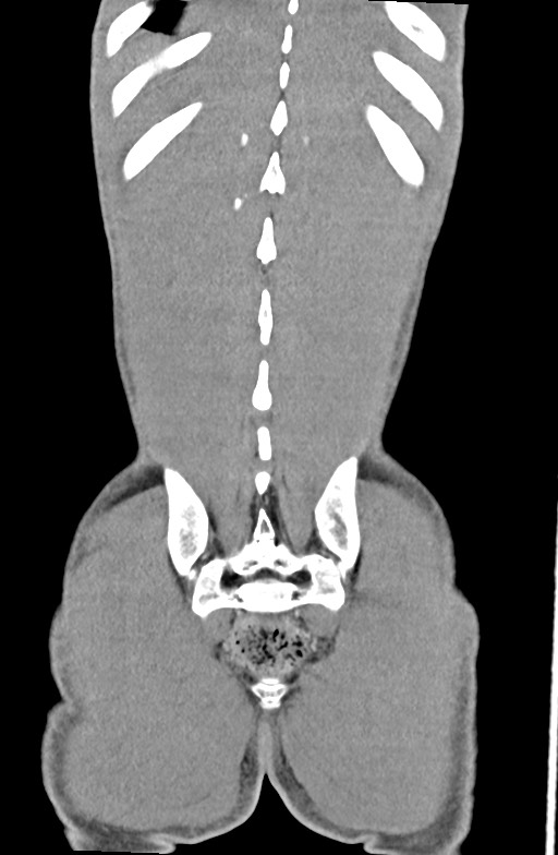 Blunt injury to the small bowel (Radiopaedia 74953-85987 B 85).jpg