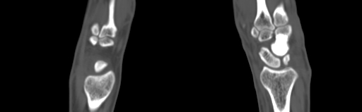 File:Bone islands - carpus (Radiopaedia 63141-71658 Coronal bone window 24).jpg