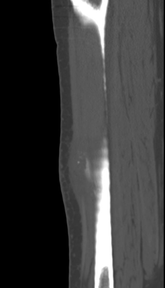 Bone metastasis - tibia (Radiopaedia 57665-64609 Sagittal bone window 114).jpg
