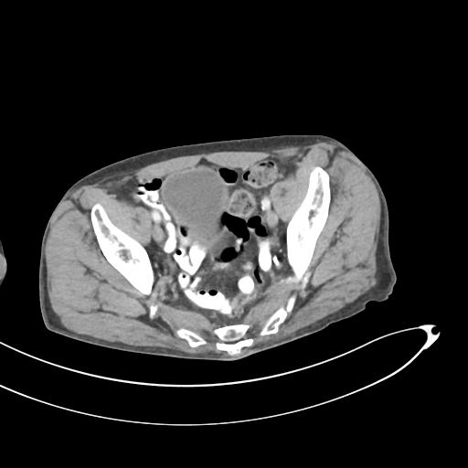 Bone metastasis from squamous cell carcinoma (Radiopaedia 30133-30730 B 64).jpg