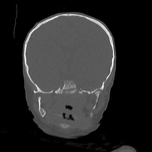 File:Bony atresia of the right external auditory canal (Radiopaedia 27916-28156 Coronal bone window 19).jpg
