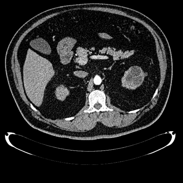 Bosniak renal cyst - type IV (Radiopaedia 24244-24518 B 111).jpg