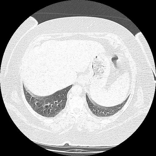 Bovine aortic arch - right internal mammary vein drains into the superior vena cava (Radiopaedia 63296-71875 Axial lung window 149).jpg