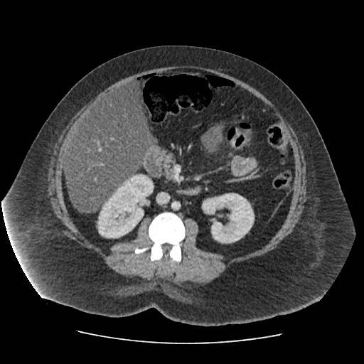 Bowel and splenic infarcts in acute lymphocytic leukemia (Radiopaedia 61055-68915 A 64).jpg
