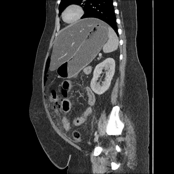 Bowel and splenic infarcts in acute lymphocytic leukemia (Radiopaedia 61055-68915 C 25).jpg