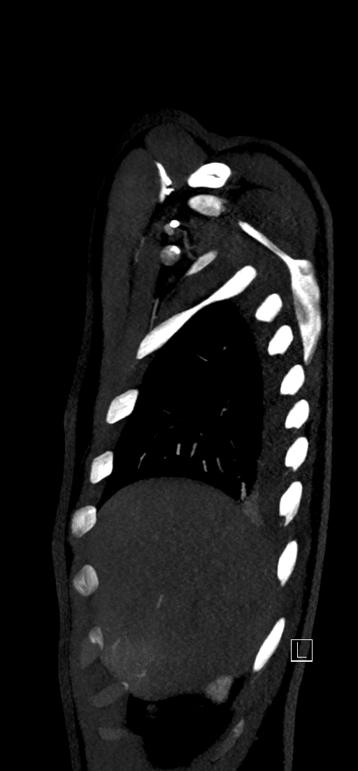 Brachiocephalic trunk pseudoaneurysm (Radiopaedia 70978-81191 C 15).jpg