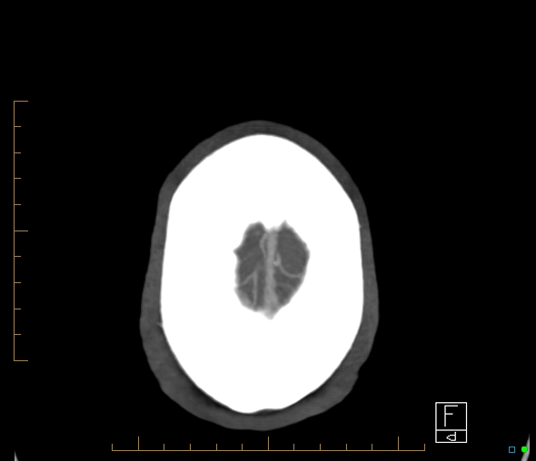 Brachiocephalic trunk stenosis (Radiopaedia 87242-103519 A 2).jpg