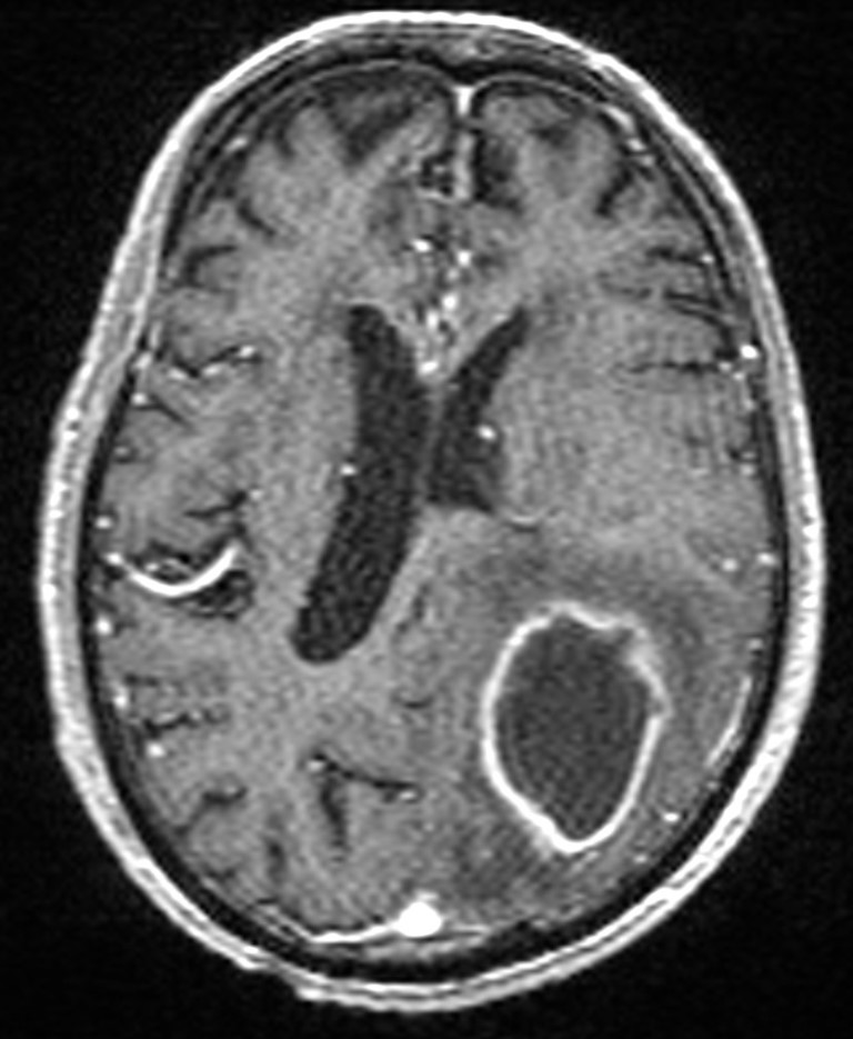 Brain abscess with dual rim sign (Radiopaedia 87566-103938 Axial T1 C+ 101).jpg