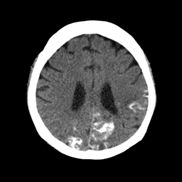 Brain cortical laminar necrosis (Radiopaedia 25822-25971 Axial non-contrast 30).jpg