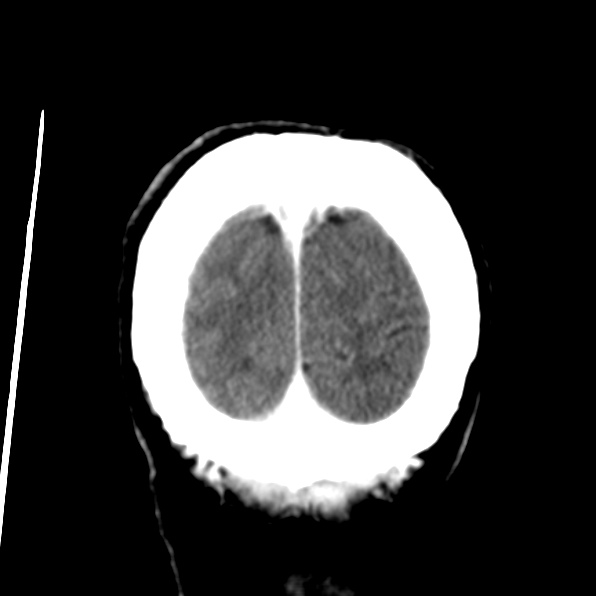 File:Brain metastases from breast cancer (Radiopaedia 23178-23231 D 36).jpg