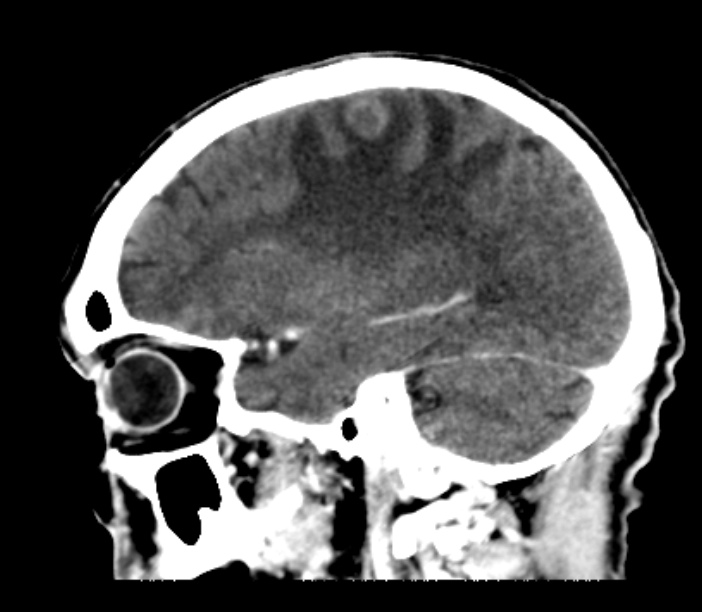 Brain metastases from lung cancer (Radiopaedia 27849-28092 Sagittal C+ delayed 20).jpg