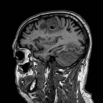 Brain metastases from lung cancer (Radiopaedia 83839-99028 Sagittal T1 95).jpg