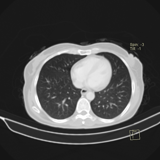 Brain metastasis as initial presentation of non-small cell lung cancer (Radiopaedia 65122-74127 Axial lung window 32).jpg