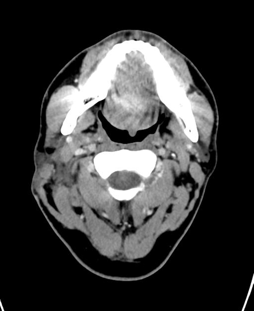 Branchial cleft cyst (Radiopaedia 31167-31875 Axial C+ delayed 17).jpg