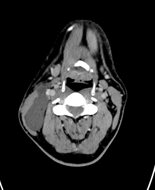 Branchial cleft cyst (Radiopaedia 31167-31875 Axial C+ delayed 28).jpg