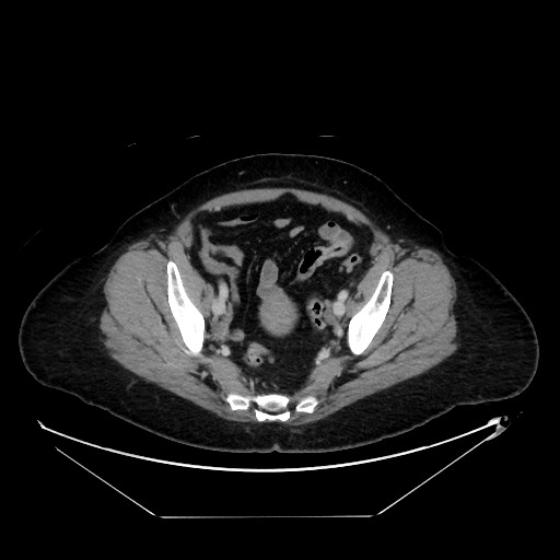 File:Breast cancer pseudocirrhosis with lobar invovlement (Radiopaedia 81080-94670 A 132).jpg