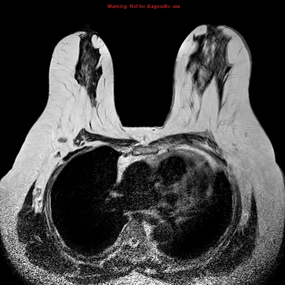 File:Breast carcinoma (multicentric multifocal in mammary Paget disease) (Radiopaedia 50966-56512 Axial T2 11).jpg