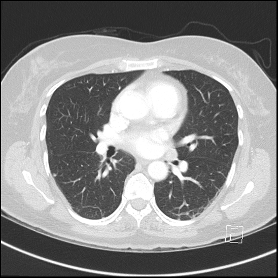 Breast metastases from renal cell cancer (Radiopaedia 79220-92225 Axial lung window 43).jpg
