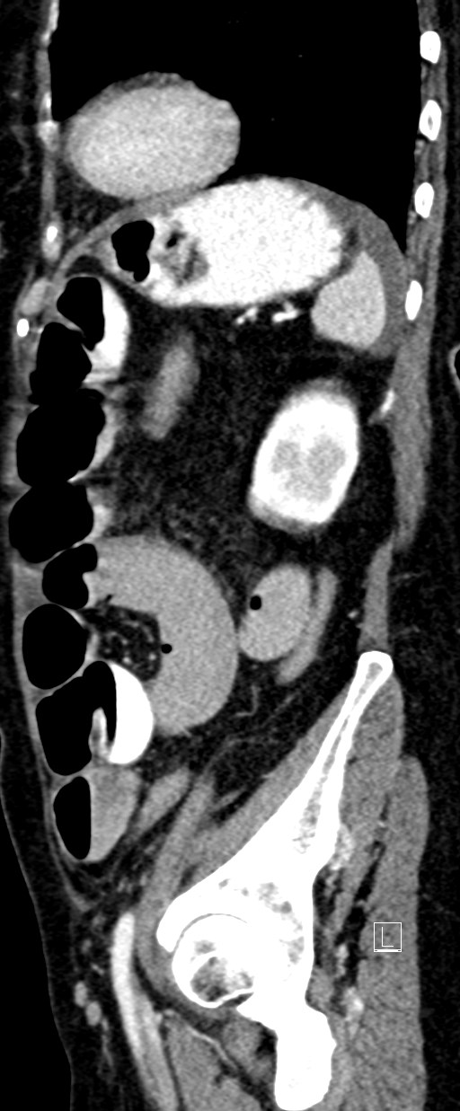Broad ligament hernia (Radiopaedia 84802-100276 C 16).jpg