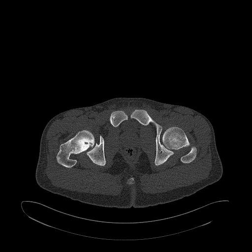 Brodie abscess- femoral neck (Radiopaedia 53862-59966 Axial bone window 168).jpg