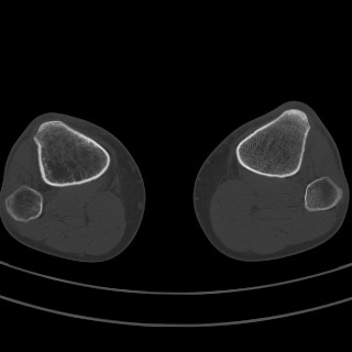 Brodie abscess - tibia (Radiopaedia 66028-75204 Axial bone window 4).jpg