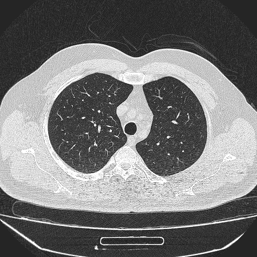 File:Bronchial atresia (Radiopaedia 58271-65417 Axial lung window 10).jpg