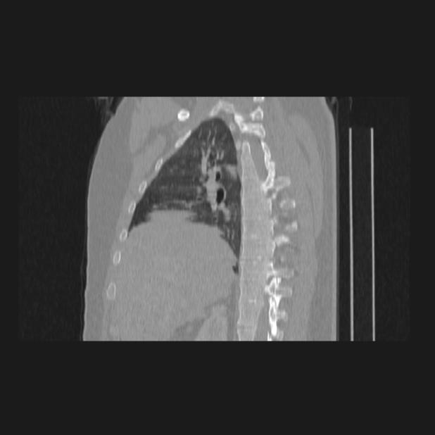 Bronchial atresia (Radiopaedia 60685-68439 Sagittal lung window 31).jpg