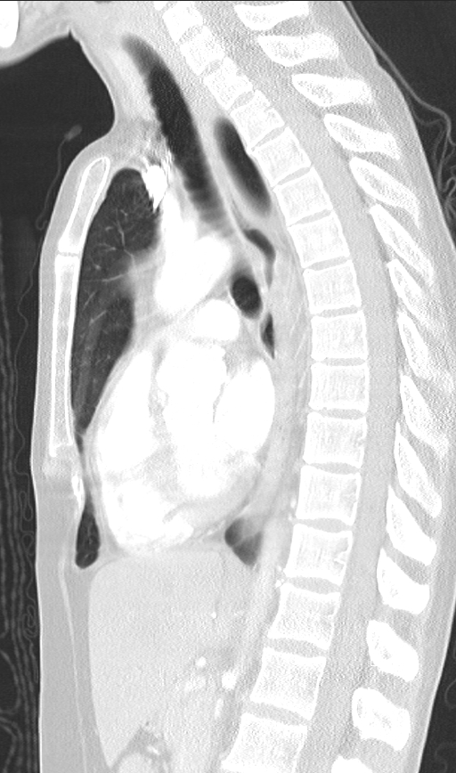 Bronchial atresia (Radiopaedia 73677-84470 Sagittal lung window 28).jpg