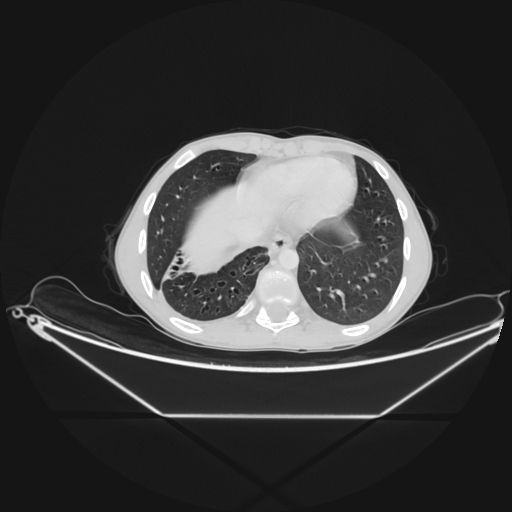 Bronchial carcinoid tumor (Radiopaedia 57187-64090 Axial lung window 63).jpg