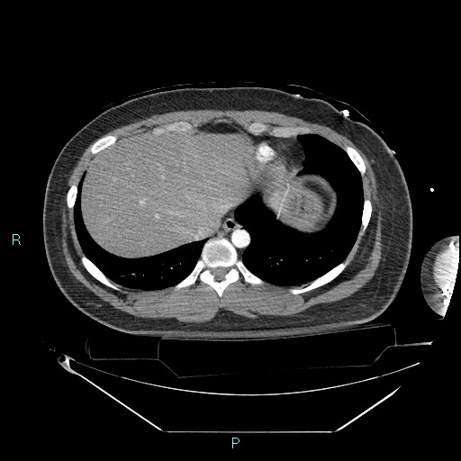 Bronchial carcinoid tumor (Radiopaedia 78272-90870 B 98).jpg