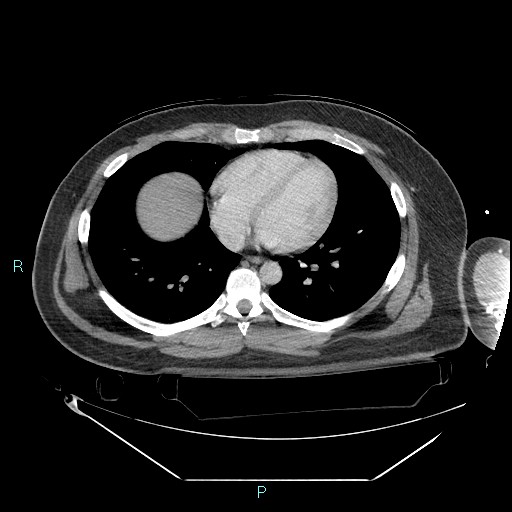 Bronchial carcinoid tumor (Radiopaedia 78272-90870 C 79).jpg