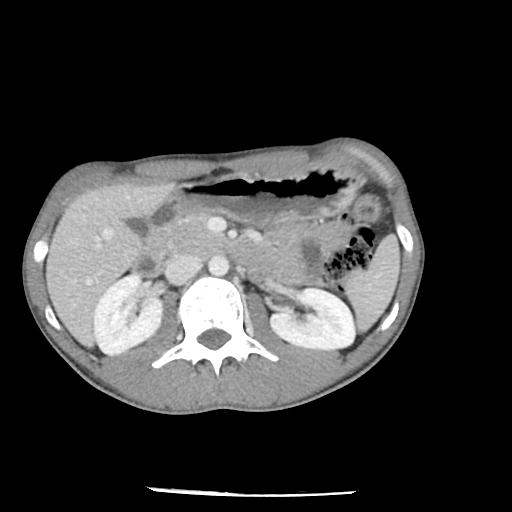 Bronchial carcinoid tumor causing right lower lobe collapse (Radiopaedia 83495-98594 A 62).jpg