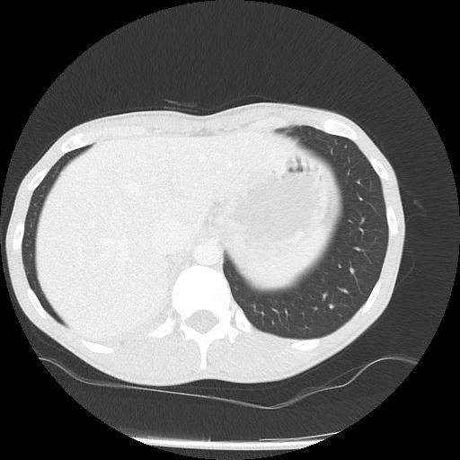 Bronchial carcinoid tumor causing right lower lobe collapse (Radiopaedia 83495-98594 Axial lung window 50).jpg