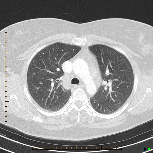 Bronchial diverticula (Radiopaedia 79512-92675 Axial lung window 17).jpg