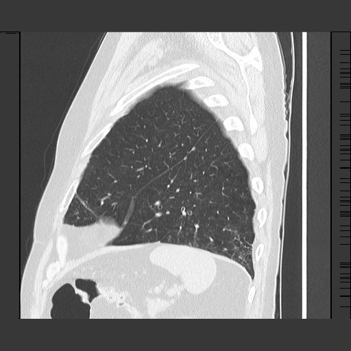 Bronchial stenosis - lung transplant (Radiopaedia 73133-83848 Sagittal lung window 56).jpg