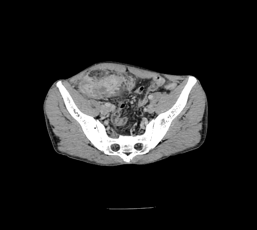 File:Bronchiectasis in Crohn disease (Radiopaedia 60311-67977 B 144).jpg